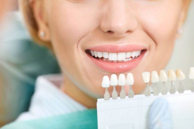 vantaggi delle faccette dentali in ceramica vantaggi delle faccette dentali in ceramica