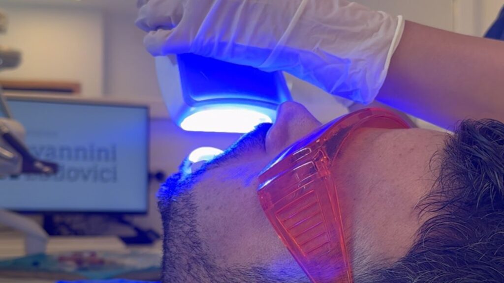 quanto dura lo sbiancamento dentale professionale