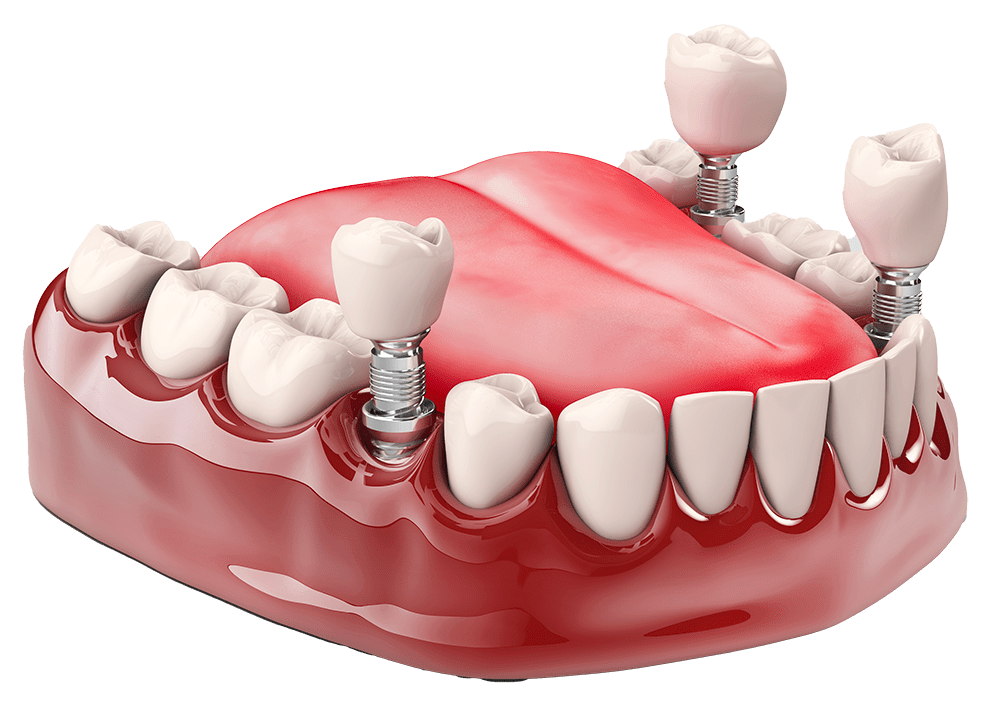 Come si fa un impianto dentale